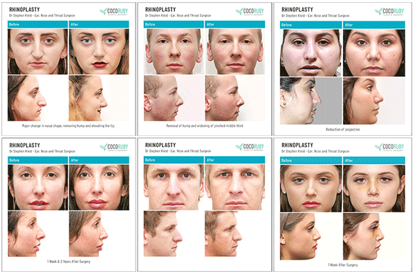 before-and-after-rhinoplasty-PHOTOS