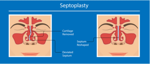 septoplasty_dr_Kleid